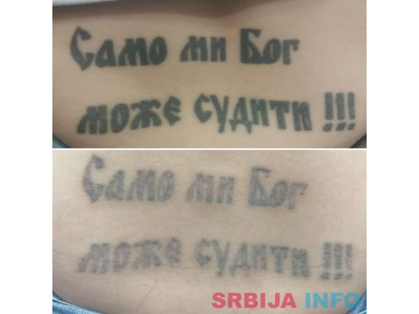 Lasersko skidanje tetovaza