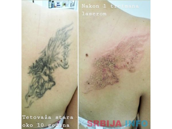 Lasersko skidanje tetovaza