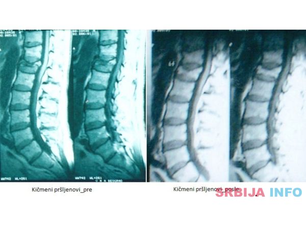 Lecenje kostiju i zglobova