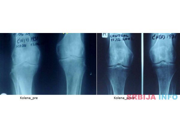 Lecenje kostiju i zglobova