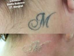 Lasersko skidanje tetovaza