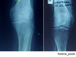 Lecenje kostiju i zglobova